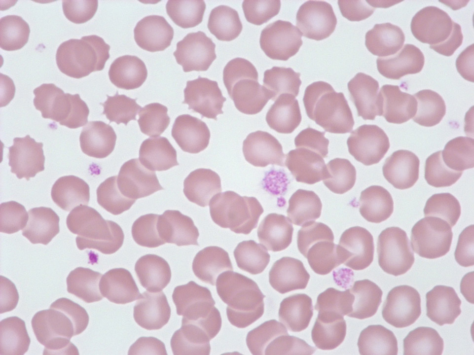 [Sysmex Egypt (english)] Anisocytosis of platelets