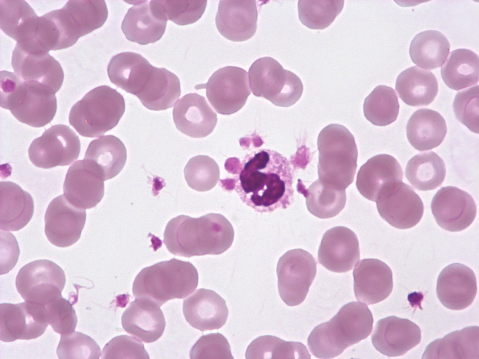 [Sysmex Egypt (english)] Accumulation of platelets on granulocytes