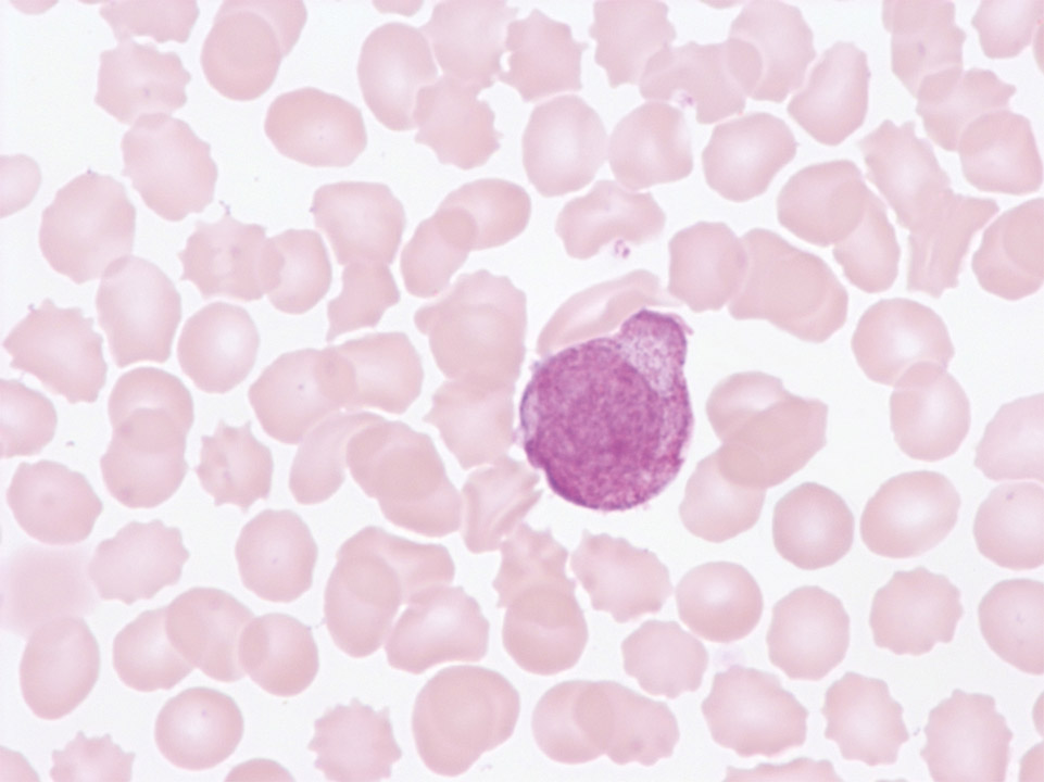 [Sysmex Egypt (english)] Atypical promyelocyte in peripheral blood
